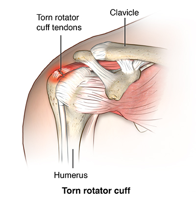 Anterior view of shoulder comparing normal rotator cuff tendons to torn rotator cuff