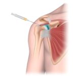 diagram of shoulder joint injections