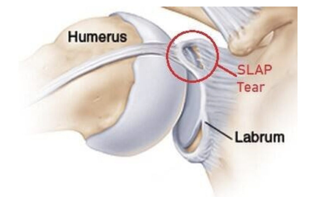 diagram of a shoulder labrum tear