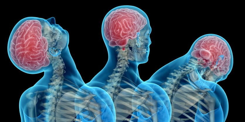 Anatomy of human body, showing neck injuries like whiplash effect. With skeleton, skin and brain concussions. Isolated on white background.